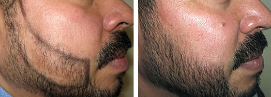 Implante De Barba