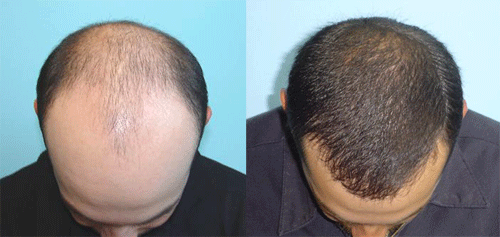 implante de cabello