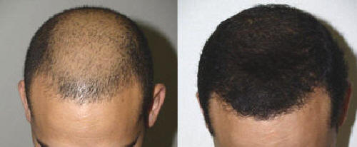 transplante de cabello